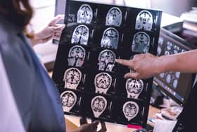 Lecanemab is designed to target and clear a protein called amyloid from patient’s brains (Photo: Adobe)