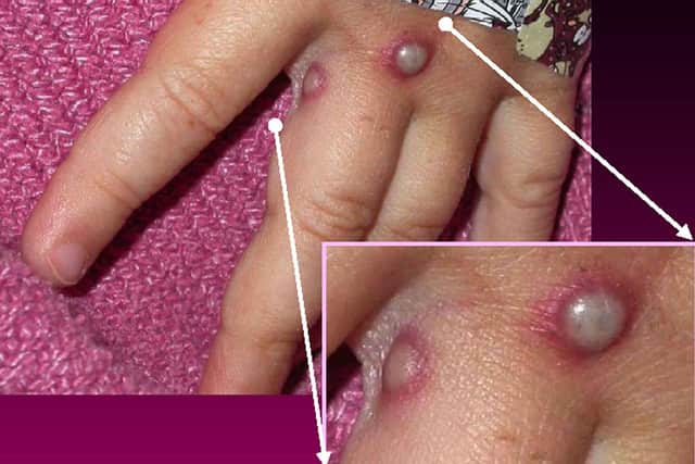 Mpox rash. (Photo: Courtesy of CDC/Getty Images)