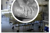 The WHO has declared a global health emergency over a mpox outbreak. (Photo: Pixabay, CDC/Getty Images)