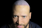 Aslı Tarcan Clinic is a leading destination for anyone considering hair transplant procedure in Turkey