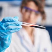 The new blood test can remove barriers to an early diagnosis