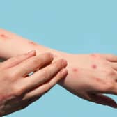 A fifth UK case of mpox Clade Ib has been found in Leeds