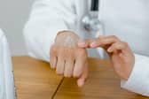Children with this common skin condition may be more likely to suffer from hay fever later in life.