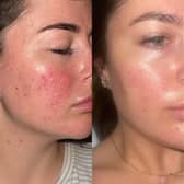These are before and after images of Jamie, another 47 Skin user