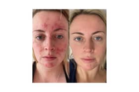 Abigail's results 47 Skin 