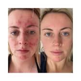 Abigail's results 47 Skin 