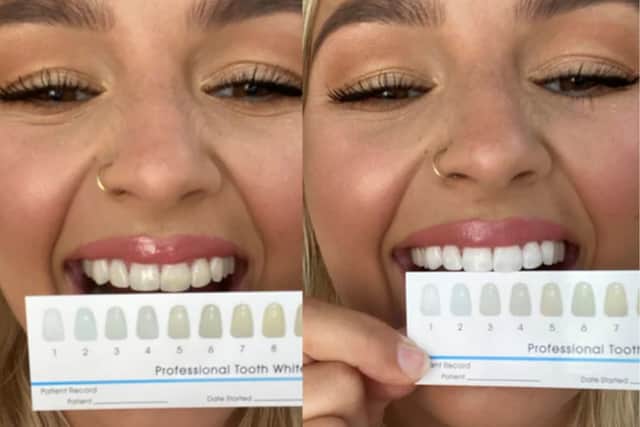 I tried SmilePro teeth whitening kit and couldn’t believe the results after one week